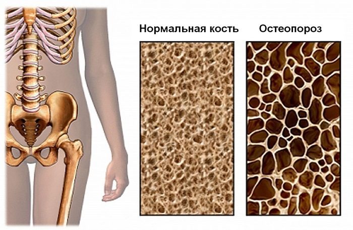 Кислые продукты выводят из организма минералы. возникает остеопороз.