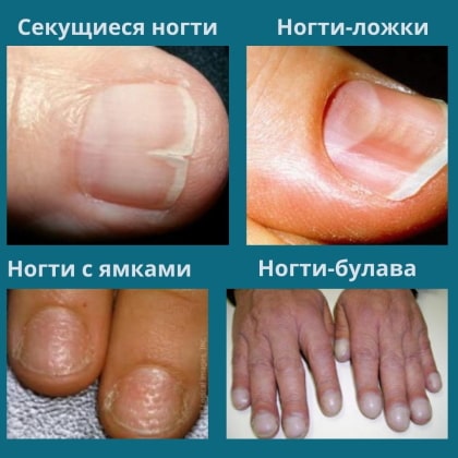 Ногти в форме ложки, ногти вогнутые, ногти с ямками, ногти-булава 